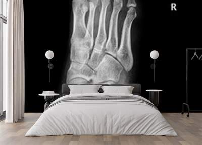 x-ray of foot fractured metatarsal bone. roken foot, oblique view, show fracture of 1th metatarsal bone. radiography, medical diagnostics, traumatology and orthopedics, rheumatology Wall mural