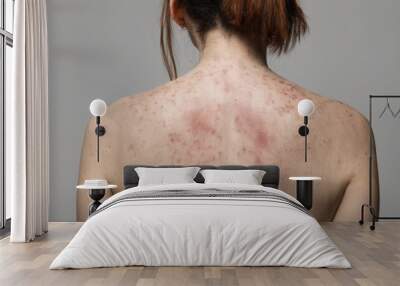  A close-up of a person's back with visible skin imperfections Wall mural