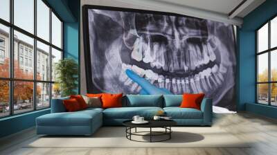 Doctor points wisdom tooth in dental x-ray. Wall mural