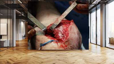 Knee Surgery.
wound on the leg with muscles expanded by surgical tools during the operation. Wall mural