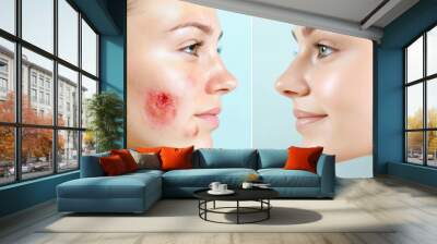 Side-by-side facial skin transformation, from red irritated acne to clear glowing skin, soft focus, detailed pore visibility Wall mural