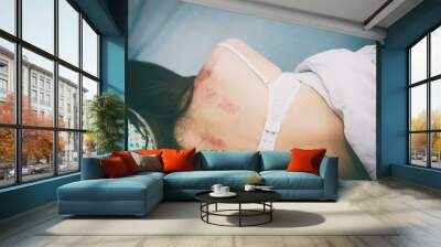 abuse woman with bruised on body Wall mural