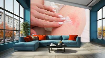 The mother is treating her child's pimple allergy with a cream. The woman is gently applying cream on the irritated skin of her baby's leg. Wall mural