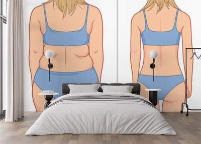 Woman's back before and after weight loss. Vector illustration. Wall mural