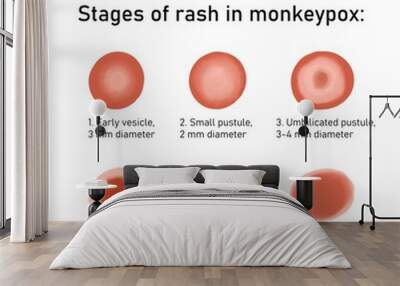 Stages of rash in monkey pox. Monkeypox virus zoonotic viral disease that can infect human, nonhuman primates. Monkey pox. Vector illustration Wall mural