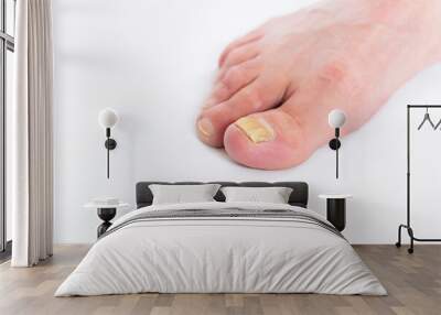 close-up of a male foot with yellow ugly fungus on toenails isolated on white background. fungal nai Wall mural