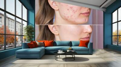 Cropped shot of a young woman's face before and after acne  treatment on face. Pimples, red scars on the cheeks and chin of the girl. Problem skin, care and beauty concept. Dermatology, cosmetology Wall mural