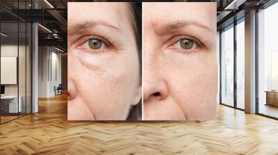 Cropped shot of an elderly caucasian woman's face with puffiness under her eyes and wrinkles before and after treatment. Age-related skin changes, fatigue. Result of blepharoplasty plastic surgery Wall mural