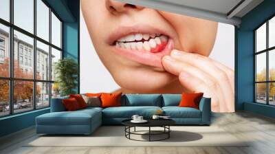 Gum inflammation. Cropped shot of a young woman showing red bleeding gums isolated on a white background. Close up. Dentistry, dental care	 Wall mural