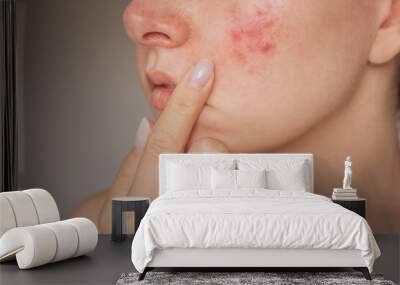 close-up photo of a young Caucasian woman suffering from the skin chronic disease rosacea on her face in the acute stage. Pink acne. Dermatological problems.  isolated on a beige background Wall mural