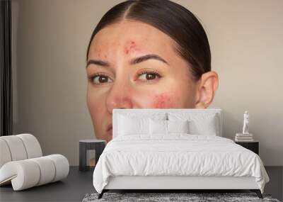 Young brunette Caucasian woman examines the pimples on her face. Girl is experiencing discomfort, suffers from a skin disease on her face-rosacea in the acute stage. Isolated on a beige background Wall mural