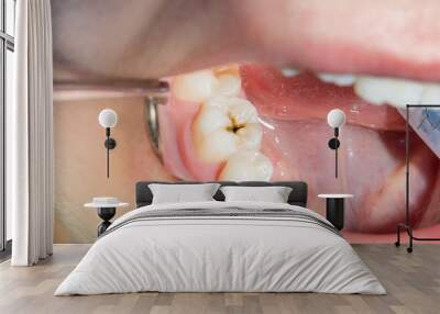 close-up of a human rotten carious tooth at the treatment stage in a dental clinic Wall mural