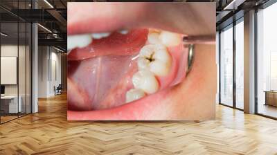 close-up of a human rotten carious tooth at the treatment stage in a dental clinic Wall mural